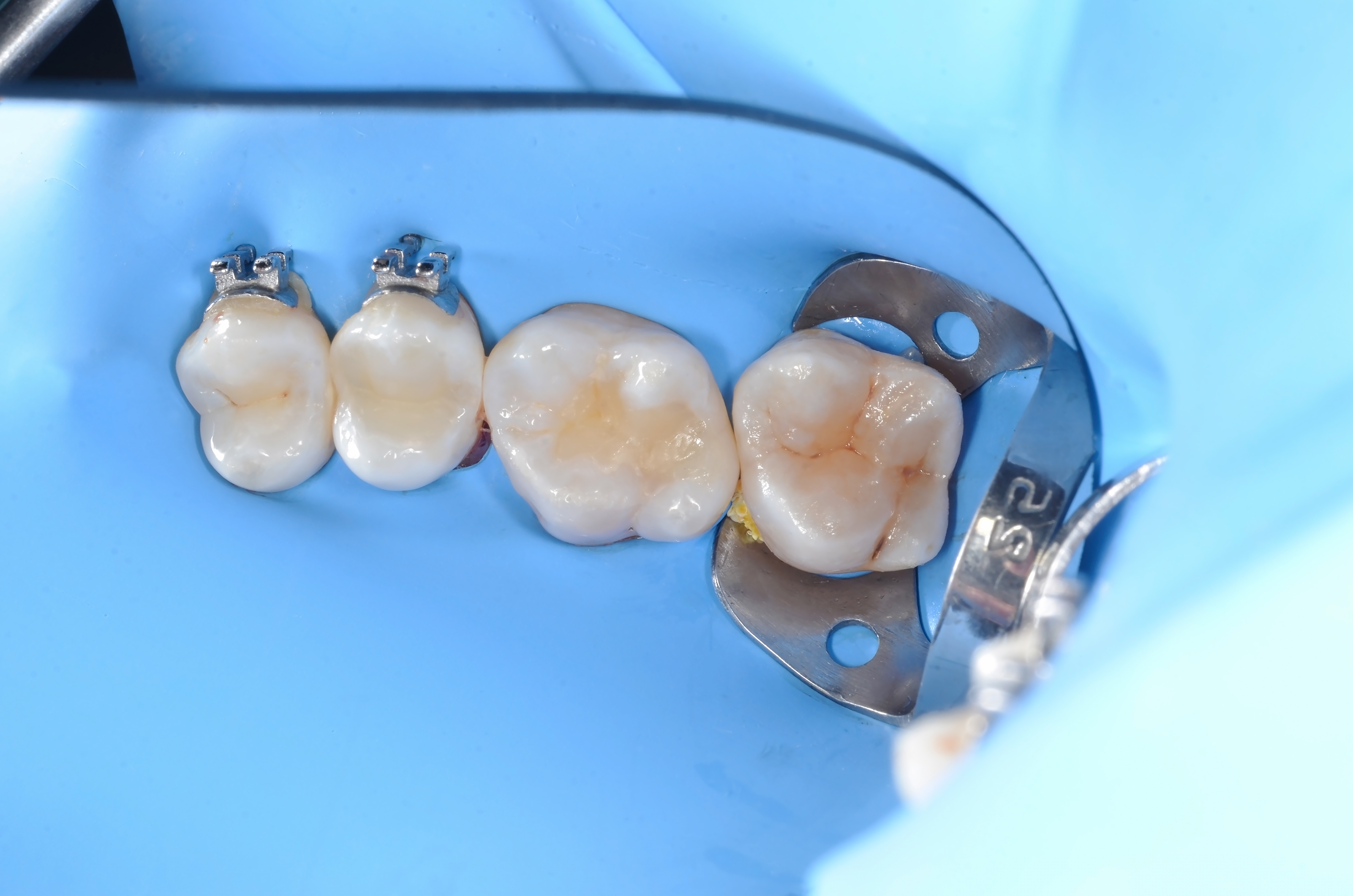 Artistic restoration and restoration of the contact point on the tooth 2.6. Close-up photo in dentist room